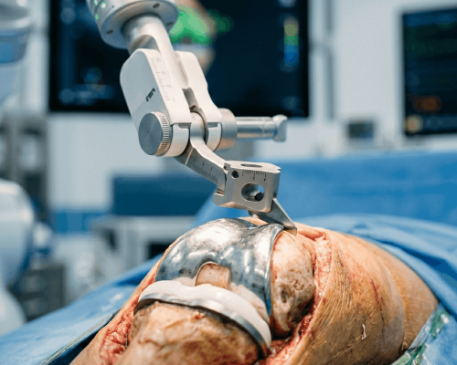 Advanced Robotic Knee Replacement Hospital in Pimpri Chinchwad