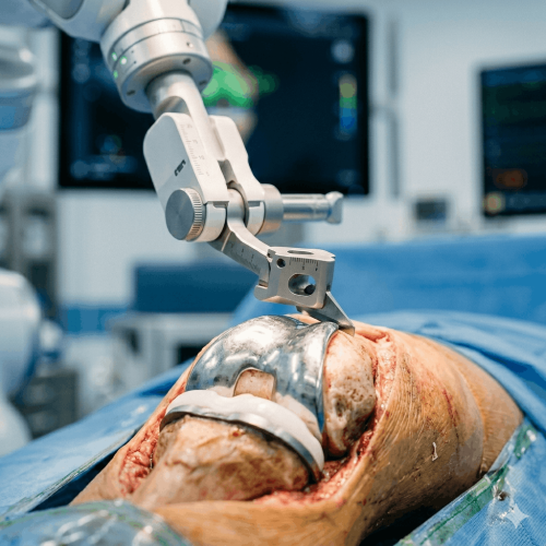 Robotic Knee Replacement Hospital in Wakad